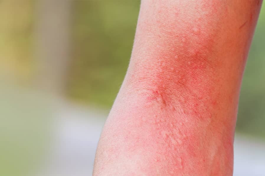 Termite bites and insect bites will look about the same but if there is swelling, contacting a medical professional is important.